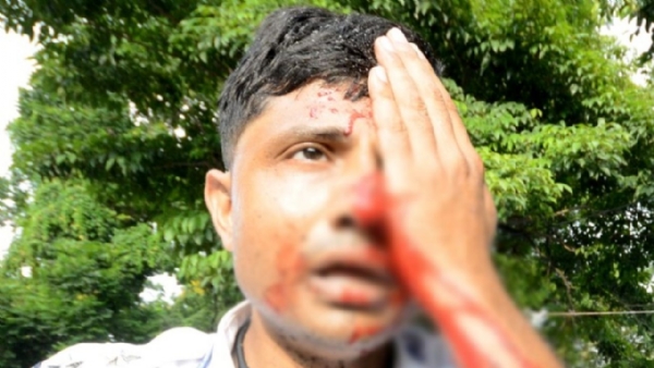 इस पुलिसकर्मी की एक आंख की रोशनी चली गई इस पुलिसकर्मी की एक आंख की रोशनी चली गई