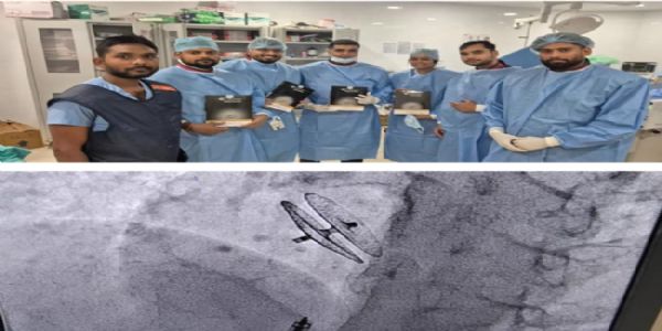 पूर्वी यूपी में पहली बार पीएफओ डिवाइस क्लोजर से क्रॉनिक माइग्रेन का सफल इलाज