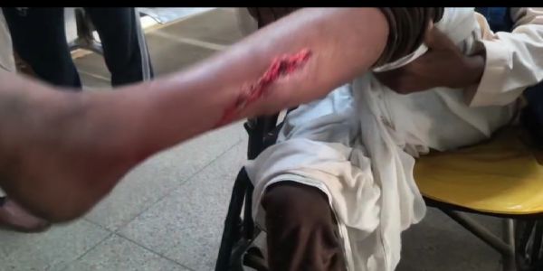 कोंच में आवारा कुत्तों का आतंक:  कुत्ते ने राह चलते नौ लोगों को नाेचा, छह की हालत नाजुक