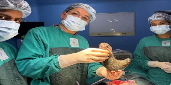 ऑपरेशन के दौरान महिला के पेट से निकला डेढ किलो बालो का गुच्छा