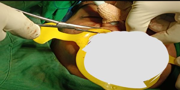 ठाणे सिविल में गंभीर रूप से जख्मी युवती के जबड़े की मुफ्त सर्जरी