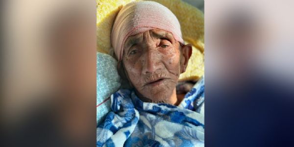 नेपाल में 103 वर्षीय वृद्धा के मस्तिष्क का सफल ऑपरेशन
