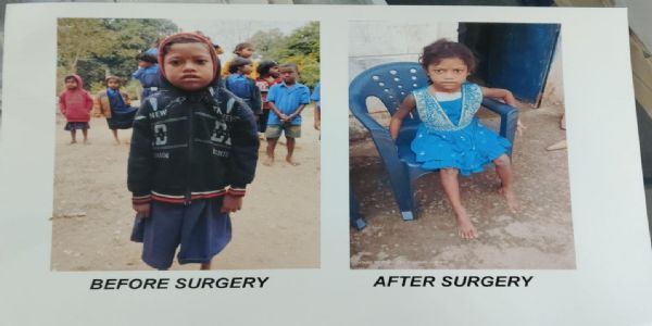 चिरायु एक वरदान- हृदय रोग से पीड़ित दिव्या ऑपरेशन के बाद जी रही है सामान्य जिन्दगी