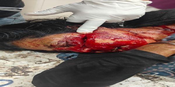 राजगढ़ः पति ने पत्नी के मुंह पर कुल्हाड़ी से किया प्रहार, हालत गंभीर