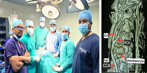 स्पॉन्टेनियस कैरोटिड आर्टरी रप्चर का छत्तीसगढ़ के अम्बेडकर अस्पताल में हुआ सफल उपचार