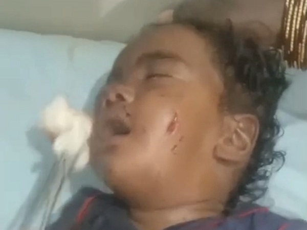 उमरिया में आवारा कुत्ते का हमला: 6 माह का मासूम गंभीर रूप से घायल, जिला अस्पताल में भर्ती