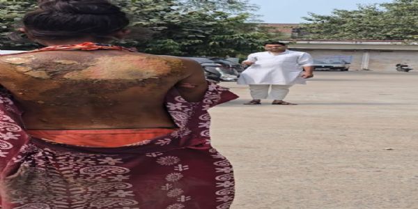 विवाहिता पर ससुरालियों ने पेट्रोल छिड़क लगाई आग