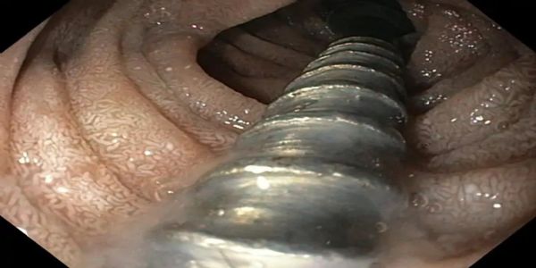 पानीपत: डॉक्टरों ने बिना चीरफाड़ के निकाली बच्ची के पेट से लोहे की कील