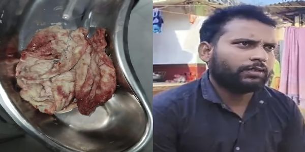 सीजर ऑपरेशन में लापरवाही, पेट में छोड़ा कॉटन, एफआईआर दर्ज