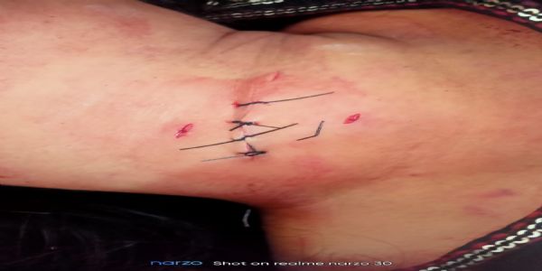 प्रेमी ने युवती की गर्दन पर किया जानलेवा हमला, फिर खुद को किया घायल