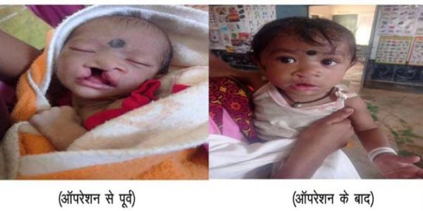 चिरायु टीम की पहल से बच्चे के चेहरे पर लौटी मुस्कान
