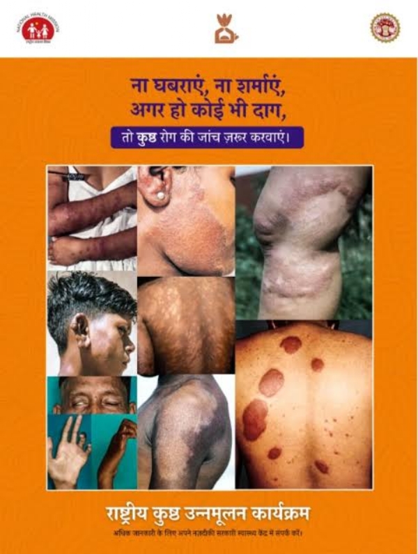 मुरादाबाद में 9 मार्च से 23 मार्च तक चलेगा कुष्ठ रोगी खोजी अभियान, घर-घर ढूंढे जाएंगे रोगी मुरादाबाद में 9 मार्च से 23 मार्च तक चलेगा कुष्ठ रोगी खोजी अभियान, घर-घर ढूंढे जाएंगे रोगी