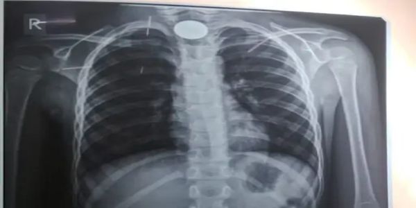 बिलासपुर: पांच रुपये का सिक्का गले में फंसा, डॉक्टरों ने बचाई मासूम की जान