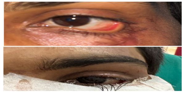 स्किन ग्राफ्टिंग से मरीज के आंखों की पलक का सफल पुनर्निर्माण