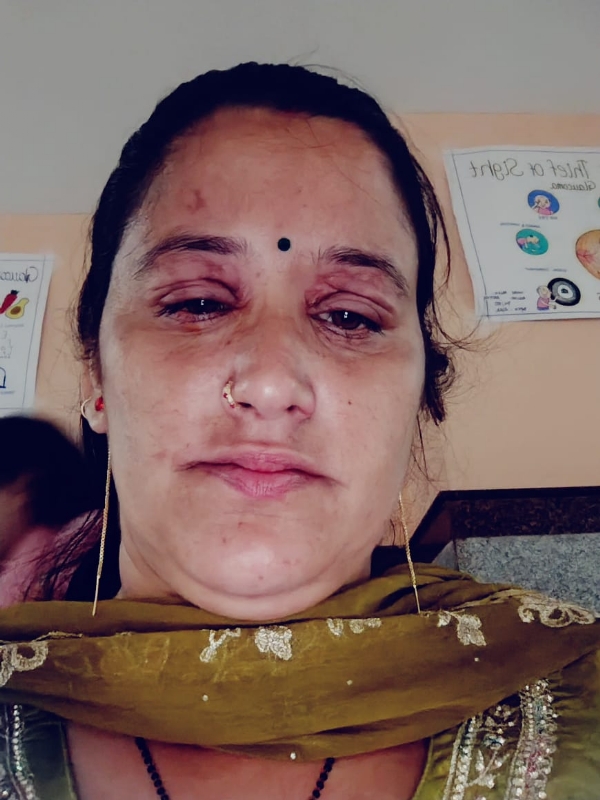घायल मिड डे मील वर्कर।