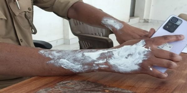 पत्नी से विवाद के बाद युवक ने थाने के बाहर खुद को लगाई आग, बचाने में थाना प्रभारी समेत तीन पुलिसकर्मी झुलसे