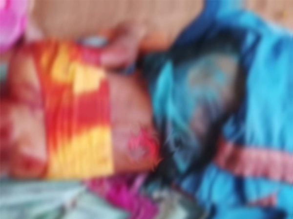 भालूओं के हमले में घायल महिला भालूओं के हमले में घायल महिला