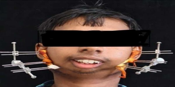 बिलासपुर के सिम्स में 24 वर्षीय युवक के बचपन से बंद जबड़े का सफल ऑपरेशन