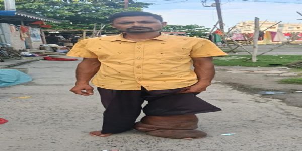 20 साल से फाइलेरिया से जंग, अब अनिल बने जागरूकता की आवाज
